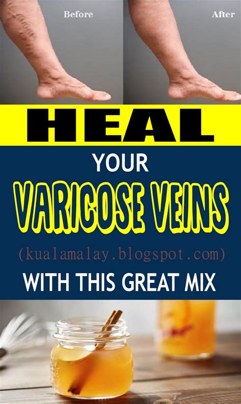 Heal Your Varicose Veins With This Great Mix