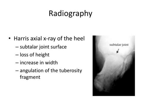 Ppt Calcaneal Fractures Powerpoint Presentation Id6578166