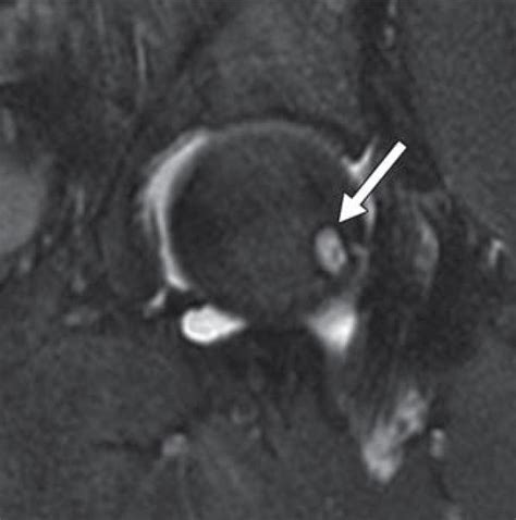 Hip Magnetic Resonance Imaging Recon Orthobullets