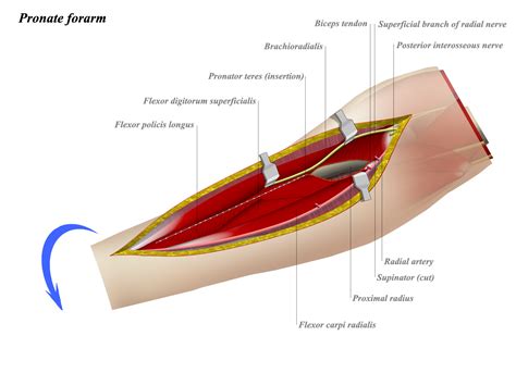 Volar Approach To Radius Henry Approaches Orthobullets