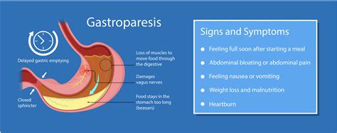 How To Treat Gastroparesis Without Medication