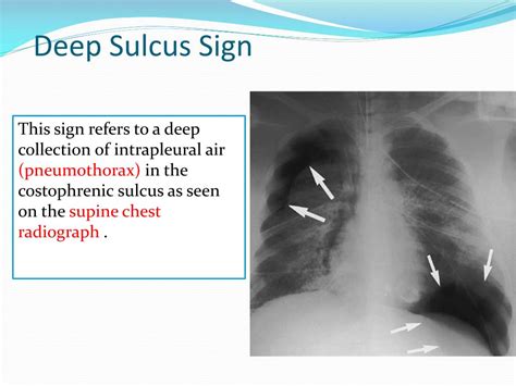 Ppt Radiological Signs Of Chest Disorders Part 1 Powerpoint