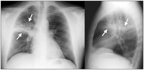 Community Acquired Pneumonia Cmaj