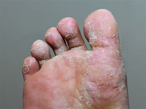 What Is Athletes Foot Symptoms Risk Factors And Treatment