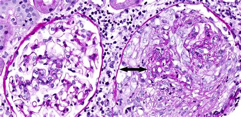 Eosinophilic Granulomatosis With Polyangiitis Clinical Pathology