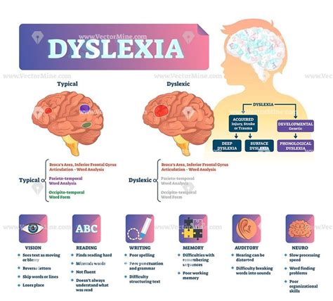 In dyslexia, the brain doesn't properly recognize or process symbols a new study finds that a brain scan may predict a dyslexic person's reading improvement.made headway in understanding what's going on in the brain of a person with dyslexia, which. Dyslexia medical disorder vector illustration infographic ...