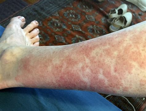 Why Hikers Rash Happens And How To Make It Less Likely Duluth News