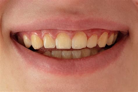 Chalky Teeth Is The Writing On The Wall Sunbury Dentist Articles And Blogs