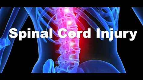 Main Causes Of Spinal Cord Injuries Gerling Law