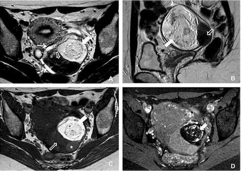 A Year Old Woman With Mature Cystic Teratoma Of The Left Ovary With
