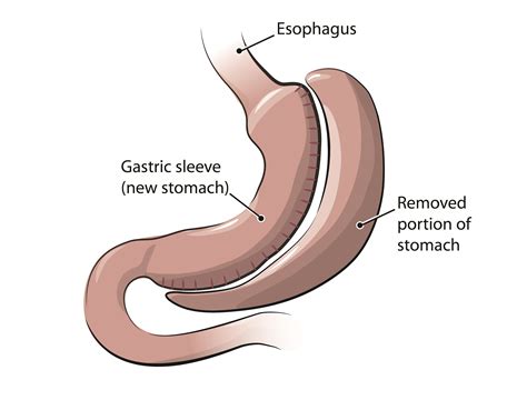 Diet After Gastric Bypass Tips Weight Loss Surgery