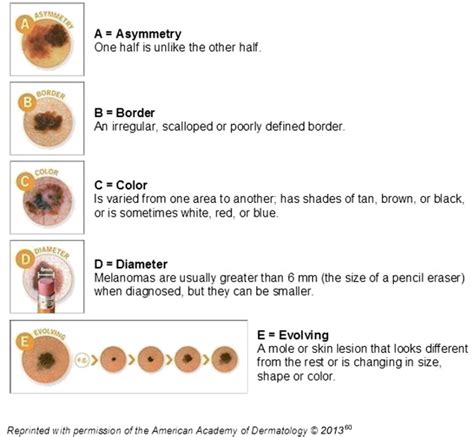 Early Detection Of Melanoma Reviewing The Abcdes Journal Of The