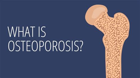 Osteoporosis Explained In Under 2 Minutes Goodrx