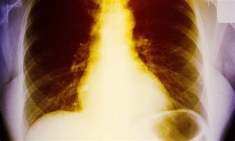 Re-building a ribcage... with plates and screws: Surgery ...