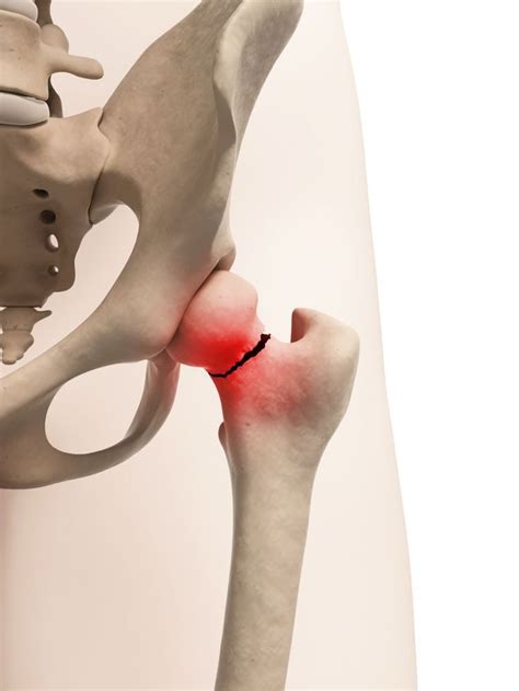 What To Do When You Break The Ball Of The Ball And Socket Hip Joint