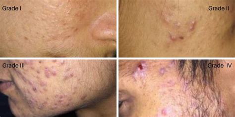 Adult Acne And Teenage Acne Causes And Treatment The Struggle Is