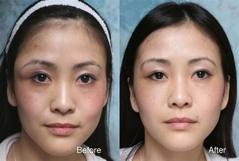 Asian Anime Eye Plastic Surgery Asian Celebrities Plastic Surgery Before And After Pictures