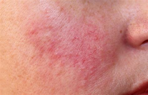 Recent Advances In Understanding And Managing Rosacea Clinical Advisor