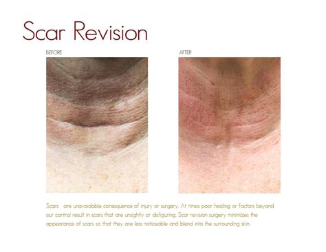 Scar Revision Drake And Presti Ent Surgical Associates