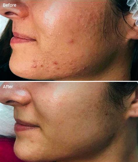 Microdermabrasion Benefits Before And Afters Side Effects Cost
