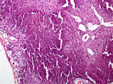 Pathology Outlines Calcifying Aponeurotic Fibroma