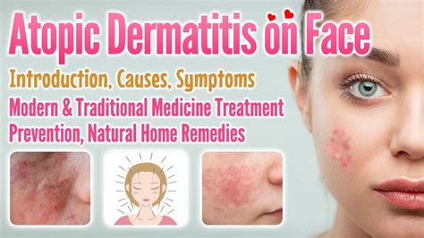 Atopic Dermatitis On Face Causes Symptoms Treatment Prevention Home