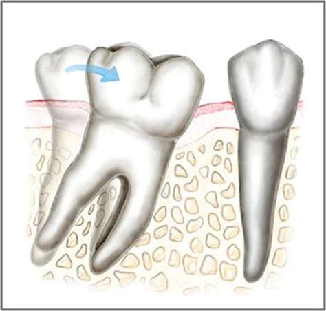 The dentist will order u a new one and u will have it in 2 weeks. Dental Implant FAQ | Pasadena Deer Park TX Implant Dentist