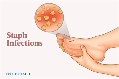 the essential guide to staph infections symptoms causes treatments and natural approaches
