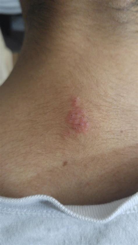 I Noticed This A Couple Of Days Ago On My Upper Neckback Area I Have