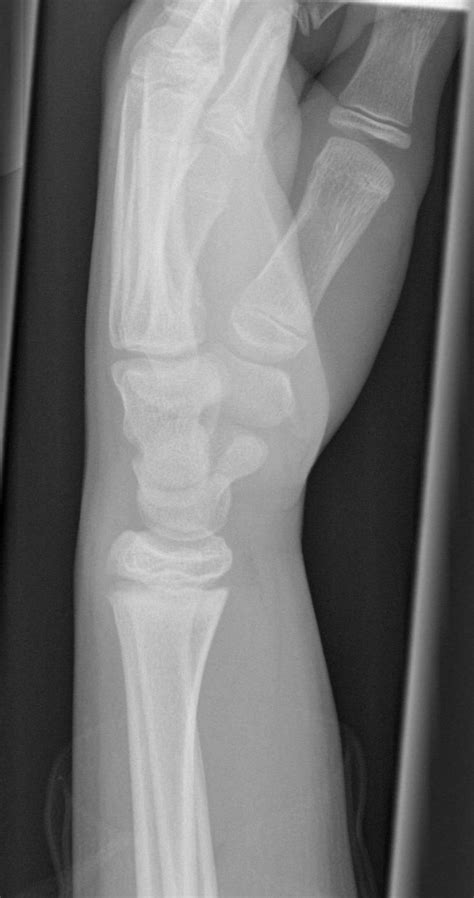 Normal Wrist X Ray 7 Years Old Image
