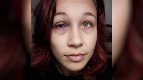 Ottawa Woman Who Got Botched Eyeball Tattoo ‘id Rather Get My Eye