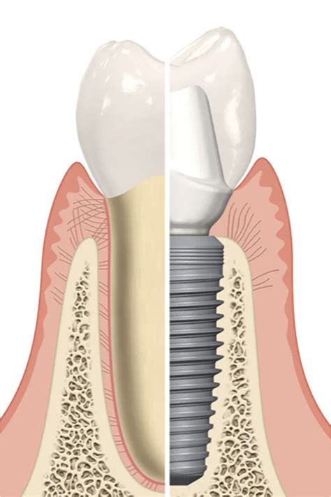 Dental Implants Northern Beaches — Dr Anthony Chellappah Northern