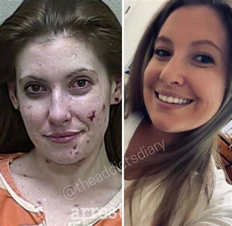 25 Before And After Pics Of People Who Quit Drugs Feels Gallery