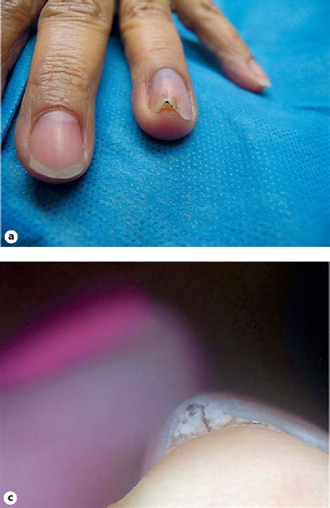 Figure 4 From Onychomatricoma With Concomitant Subungual Glomus Tumor