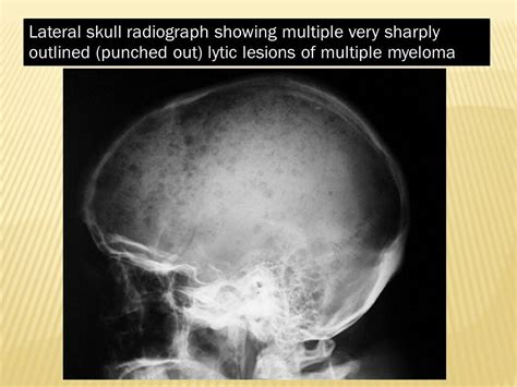 The pelvis contains numerous lytic lesions without reactive sclerosis which have multiple myeloma. Multiple myeloma ..... | Multiple myeloma, Myeloma, Radiology
