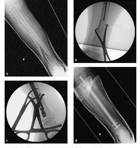 Figure From The Percutaneous Use Of A Pointed Reduction Clamp During Intramedullary Nailing Of