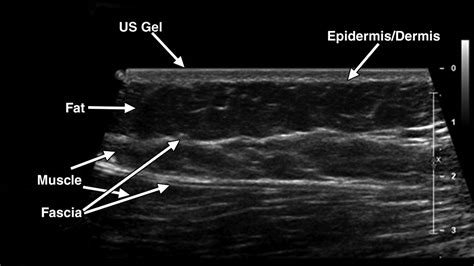 Sonography Of Musculoskeletal Soft Tissue Masses Techniques Pearls