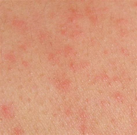 Hiv Rash What Does It Look Like And How Is It Treated Vrogue