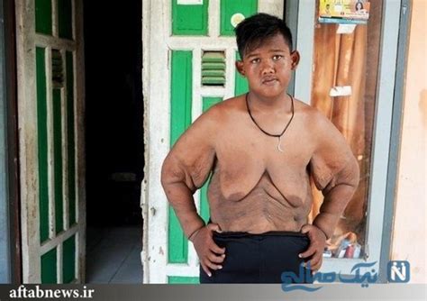 کاهش وزن ۱۱۰ کیلوگرمی چاق ترین پسر جهان تصاویر نشان آنلاین