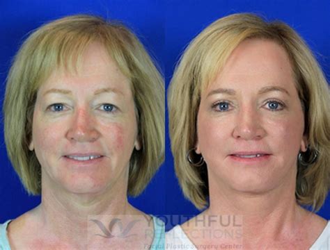 Co2 Laser Skin Resurfacing Before And After Photos Patient 84 Nashville