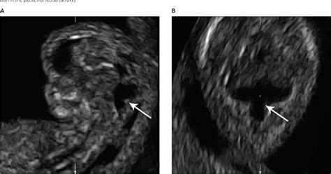 Figure 5 From First Trimester Sonographic Findings Associated With A