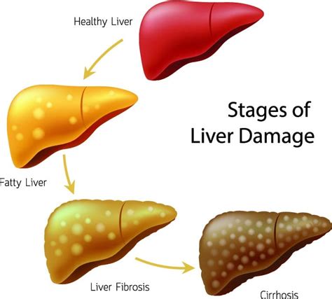 Early Symptoms Of Liver Disease In Alcoholics And Non Alcoholics