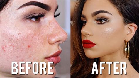 Makeup For Deep Pitted Acne Scars