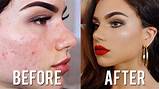 Photos of Cover Up Acne Scars With Makeup