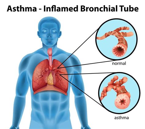 Treating Asthma With Chiropractic Care Abundant Life Chiro