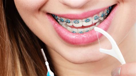 Como Passar Fio Dental No Dente Com Aparelho 6 Principais Dicas