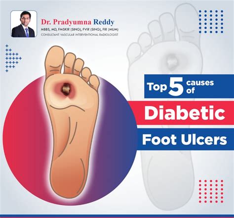 Top 5 Causes Of Diabetic Foot Ulcers