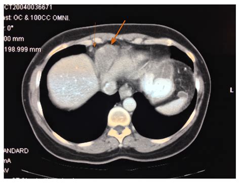 Malignant urachal neoplasms are also rare, representing less than 0.5% of all bladder cancers (, 33). Unusual radiologic presentations of malignant peritoneal ...