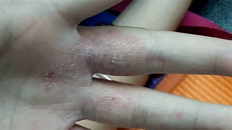One Hand Skin Involved Think Fungus Especially If Peeling Skin Tinea