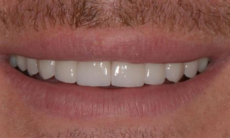 Results From Veneers Brisbane Qld Cosmetic Dental Procedure
